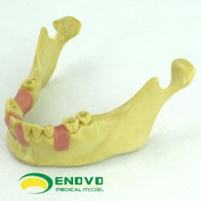 IMPLANT08 (12619) Modèle de formation dentaire d&#39;implant oral pour les implants dentaires manquants